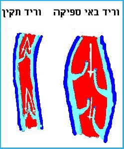 העלמת ורידים העלמת ורידים