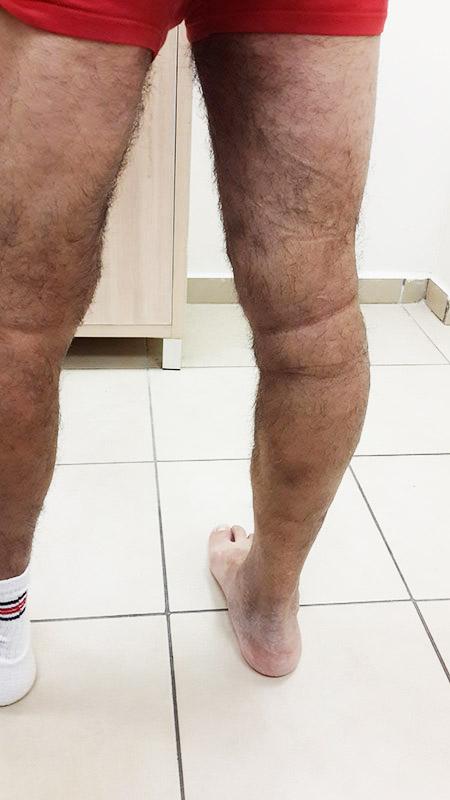 העלמת ורידים ברגליים ורידים